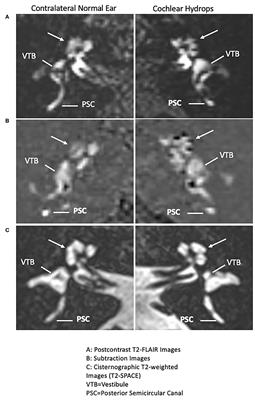 Cochlear Meniere's: A Distinct Clinical Entity With Isolated Cochlear Hydrops on High-Resolution MRI?